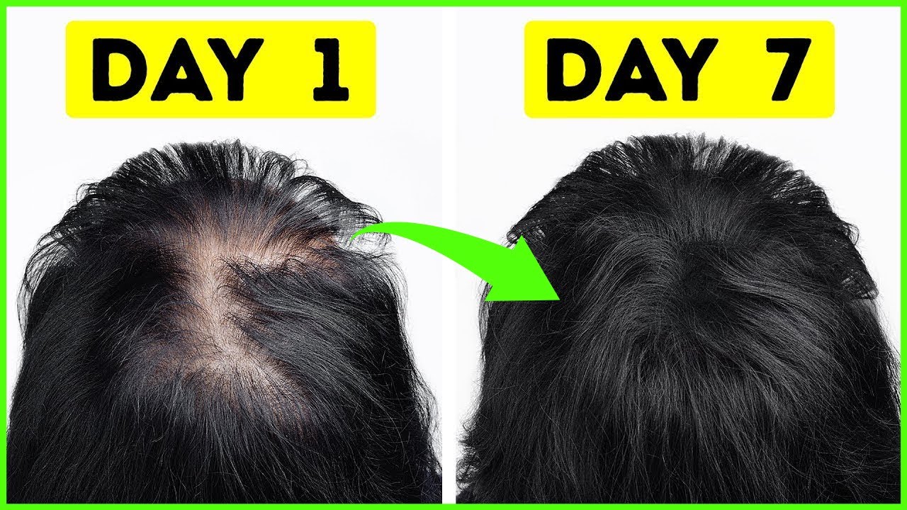 BEST HAIR GROWTH REMEDY TO GROW HAIR IN 1 WEEK || FIX HAIR FALL PROBLEM ...