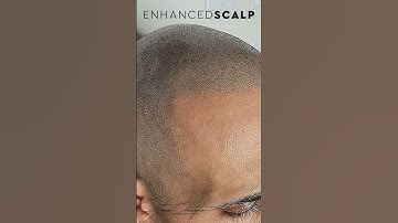 SMP Transformation, super realism coming out of Enhanced Scalp Toronto