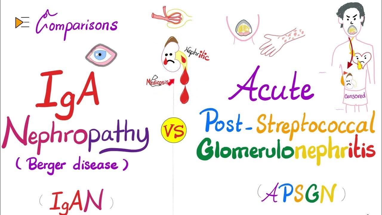 IgA Nephropathy (IgAN) vs Acute PostStreptococcal Glomerulonephritis