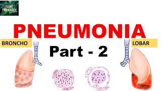 Pneumonia  |Part 2 |Community acquired bacterial pneumonia | Lobar Vs Bronchopneumonia