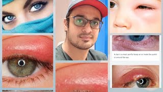 Eyelids | Anatomy | Eyelids Swellings | Clinical Ophthalmology