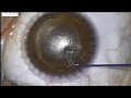 Small-Incision Lenticule Extraction (ReLEx SMILE)