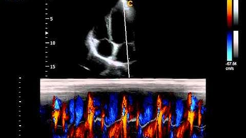 Chison Qbit CardiacCM Ultrasound of the heart Color Doppler