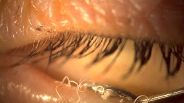 Meibomian Gland Dysfunction (MGD)