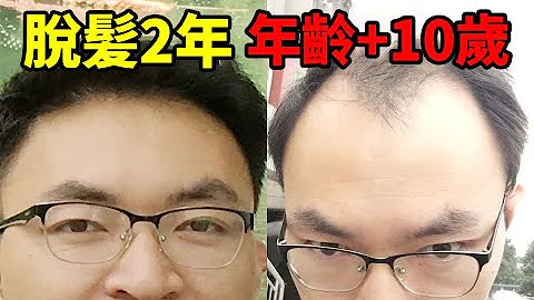 【脱发治疗】如何有效治疗脱发？临床治疗脱发有效的3种方法丨植发医生徐鲁 - 天天要闻