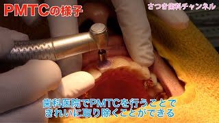 【青森_十和田市_歯医者】理由と価値がある！３ヶ月に１度ＰＭＴＣ_さつき歯科チャンネル043（口腔ケアチャンネル）