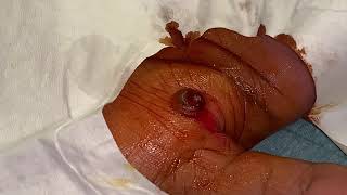 removal of granuloma from a hand