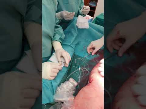 Video: Odstranjevanje Hemoroidov: S Kirurškim Posegom In Brez Kirurškega Posega