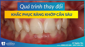 Niềng răng mắc cài sứ - khắc phục răng khớp cắn sâu | Nha khoa quốc tế Athena