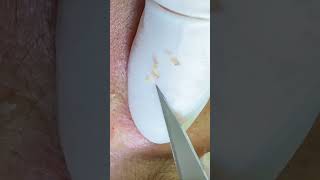 Blackhead removal / Lyn Spa Channel short