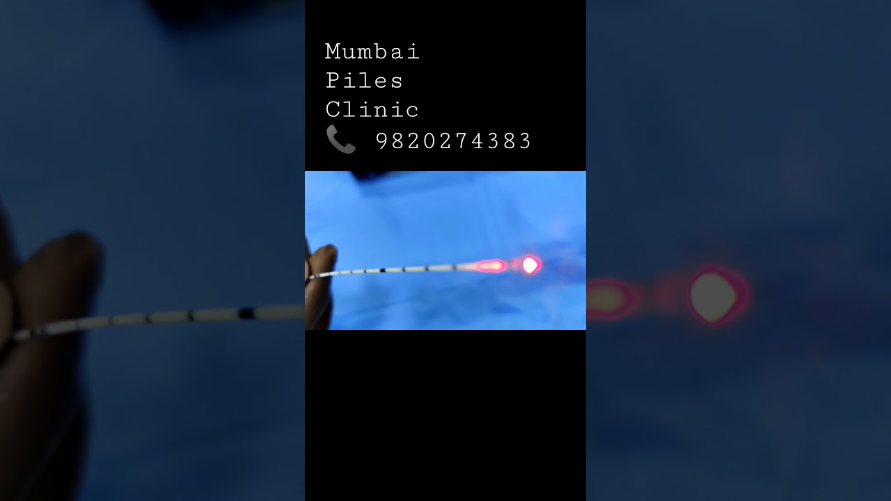 FiLAC laser fiber || Pilonidal sinus || Anal Fistula || Dr Sambit Patnaik