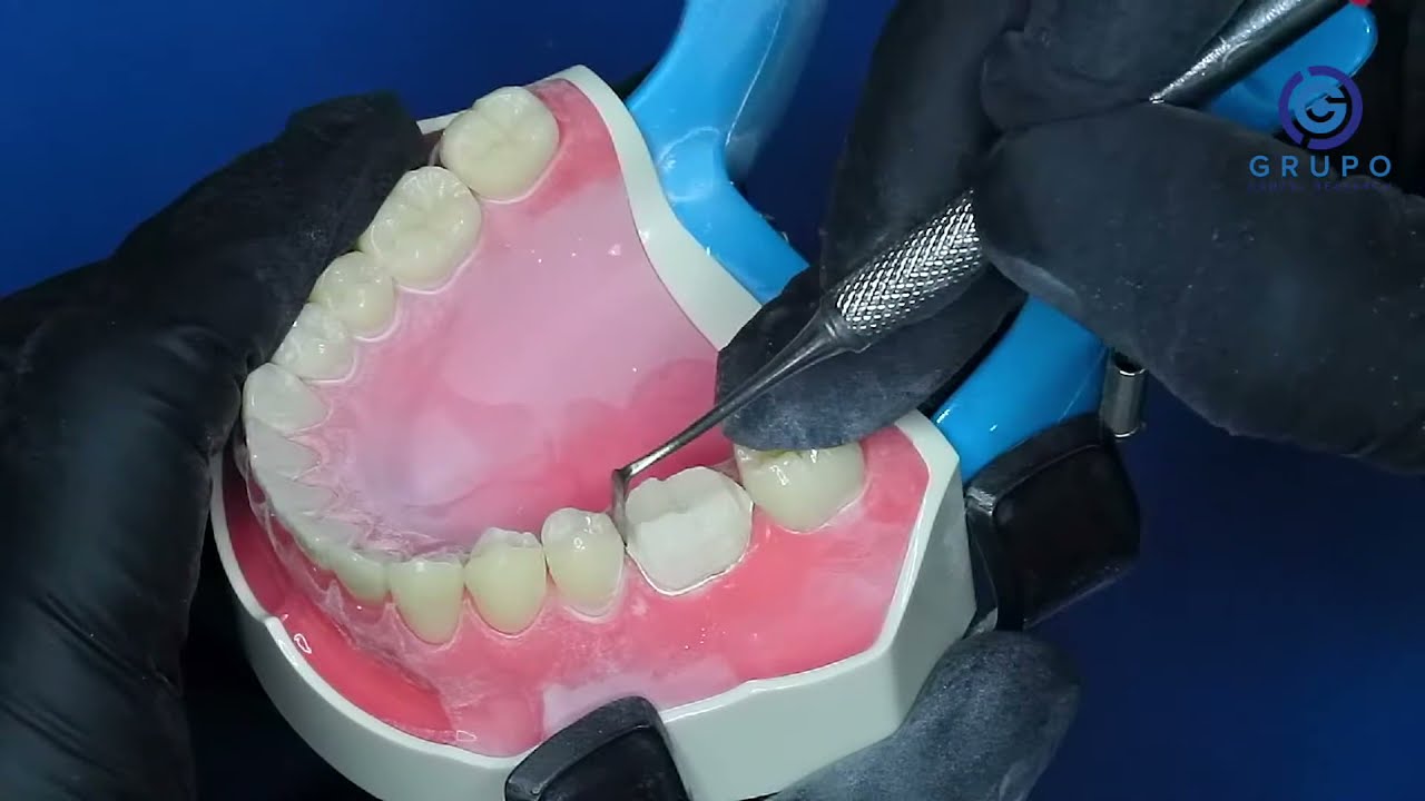 Preparo dental para coroa total metalocerâmica de molar