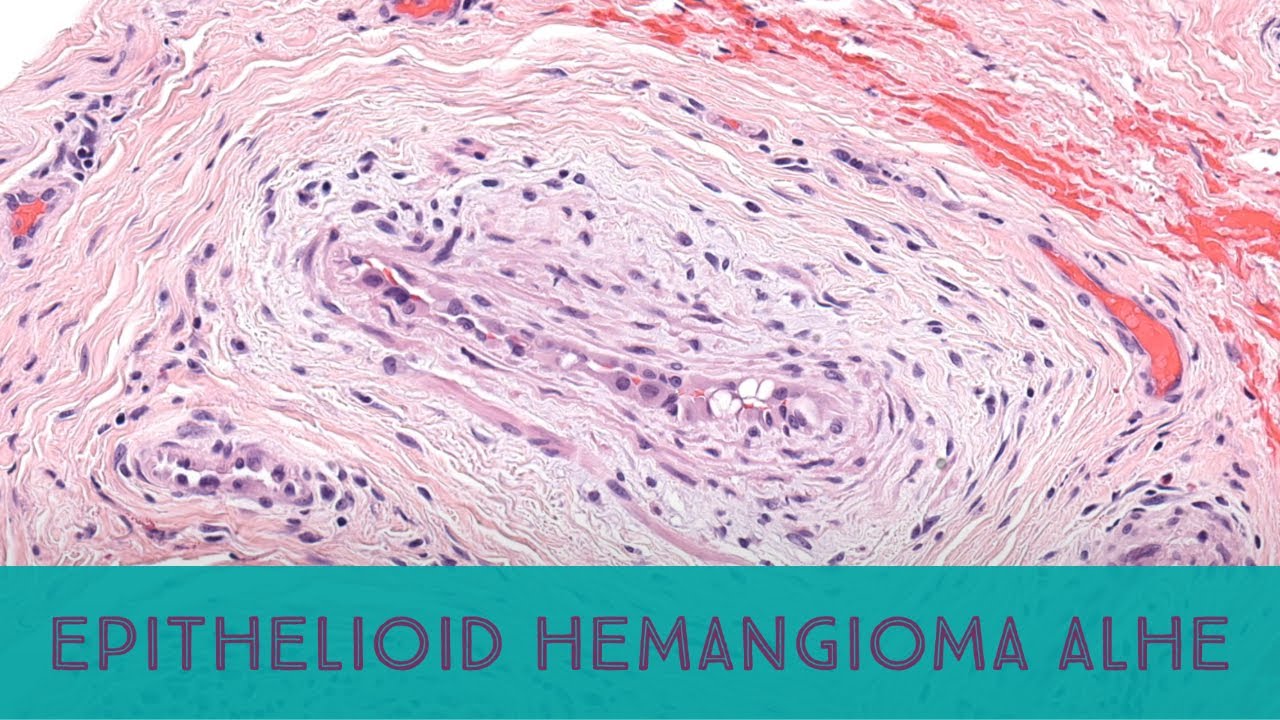Epithelioid hemangioma/angiolymphoid hyperplasia w eosinophilia ...