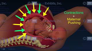 Shoulder Dystocia