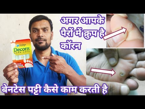 Decorn CORN CAPS/डेकाेर्न कॉर्न कैप्स/पैरों में क्रुप और कॉरन को कैसे ठीक करें/pairon Mein taklif