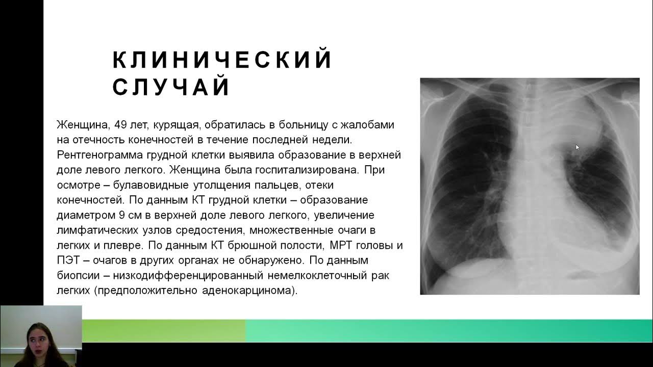 Два синдром. Два синдром