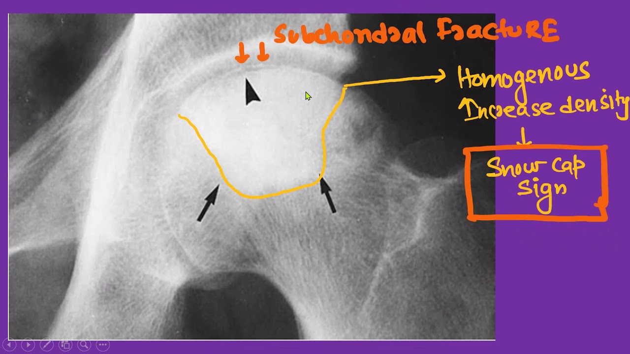 OSTEONECROSIS IMAGING - YouTube