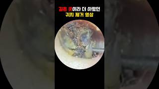 깊은 곳의 귀지 제거 영상