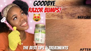 HOW TO GET RID OF RAZOR BUMPS / INGROWN HAIRS 🐱 + Preventions | Feminine Hygiene 🌸 | Naimah