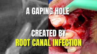Bone Grafting a Site COMPLETELY WRECKED by a Big A** Root Canal Infection