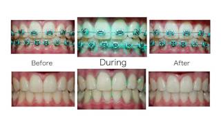 PLAQUE HD - ORAL SCIENCE || Step By Step Instructional Video