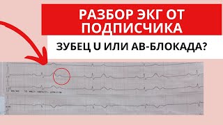 Разбор ЭКГ от подписчика. АВ-блокада или зубец U?