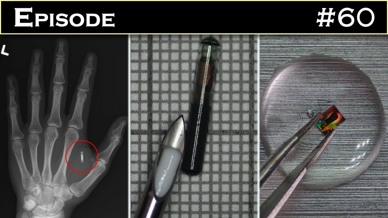 Bio implant sous-cutanée, quand la fiction devient réalité