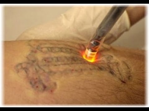 Laser Tattoo Removal and How Does it Actually Work  AK Aesthetics