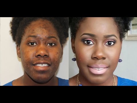 Hyperpigmentation With Omolewa Makeup