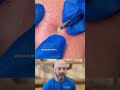 Removing Blackheads with a Comedone Extractor #skincare #blackheads
