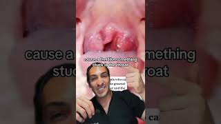 Tonsil Stones