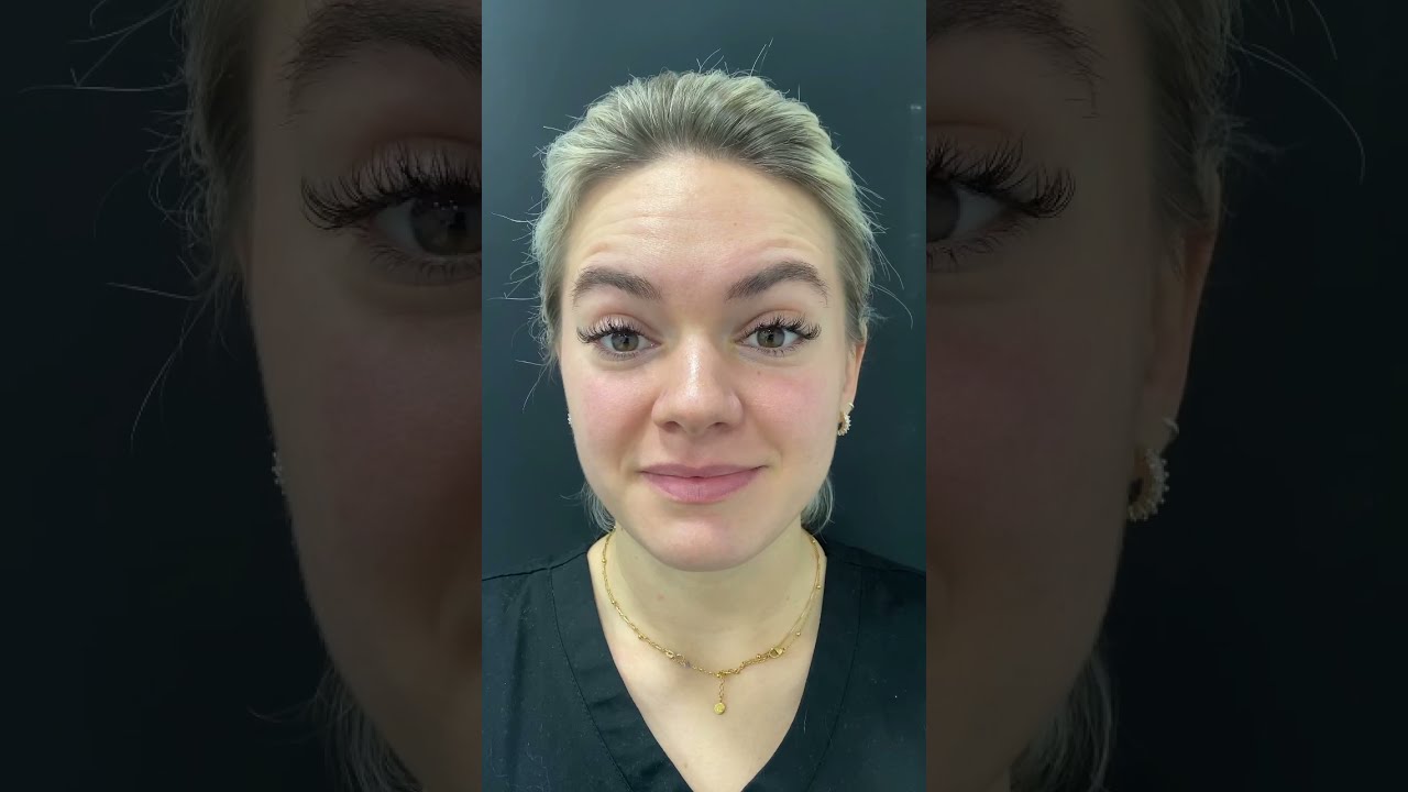 Here S What Your Botox Will Look Like Over 7 Days 