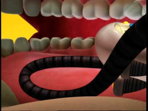 Video: De Ce Mă Rănesc Dinții?