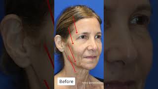 Age 64: Her Facelift Turned Back Time 20 Years!