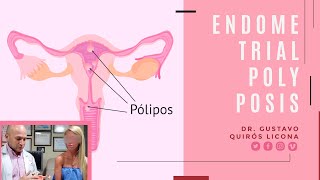 Tumor Benigno En Útero, Polipo Endometrial, Tratamiento