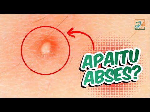 Video: Abses Kulit: Penyebab, Diagnosis, Dan Perawatan