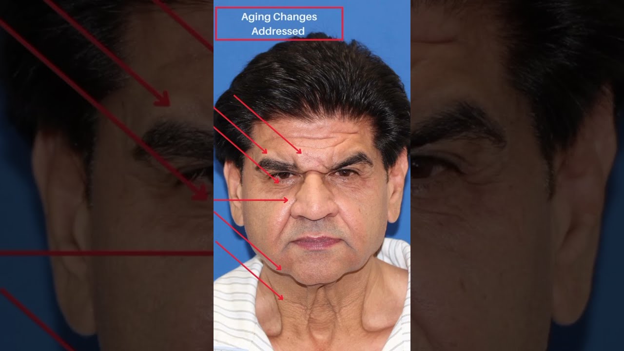 Man S TRANSFORMATIVE Facelift Makes Him Look 15 YEARS YOUNGER 