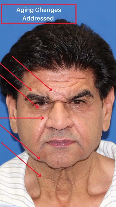 Man's TRANSFORMATIVE Facelift Makes Him Look 15 YEARS YOUNGER!