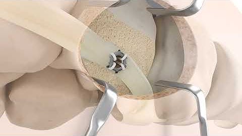 Coronet Soft Tissue Fixation System Kidner Animation from CoNextions Medical