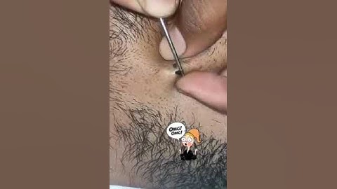 Nhổ Lông mọc ngược siêu nhiều | Tạp Nham TV. #cover  #tiktok