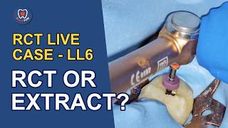 EP133# Should I Even Root Canal This Tooth? A Last-Chance Molar