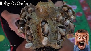 Ohh God!!! Dandruff Scratching  Removing Biggest Worms On Man's Head #640