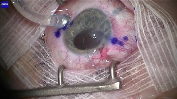 Yamane technique : flangled intrascleral IOL fixation with double needle