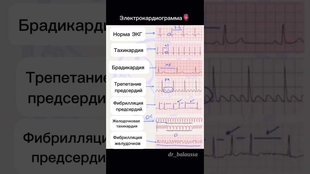 EKG Lentadagi Yurak Impulsi