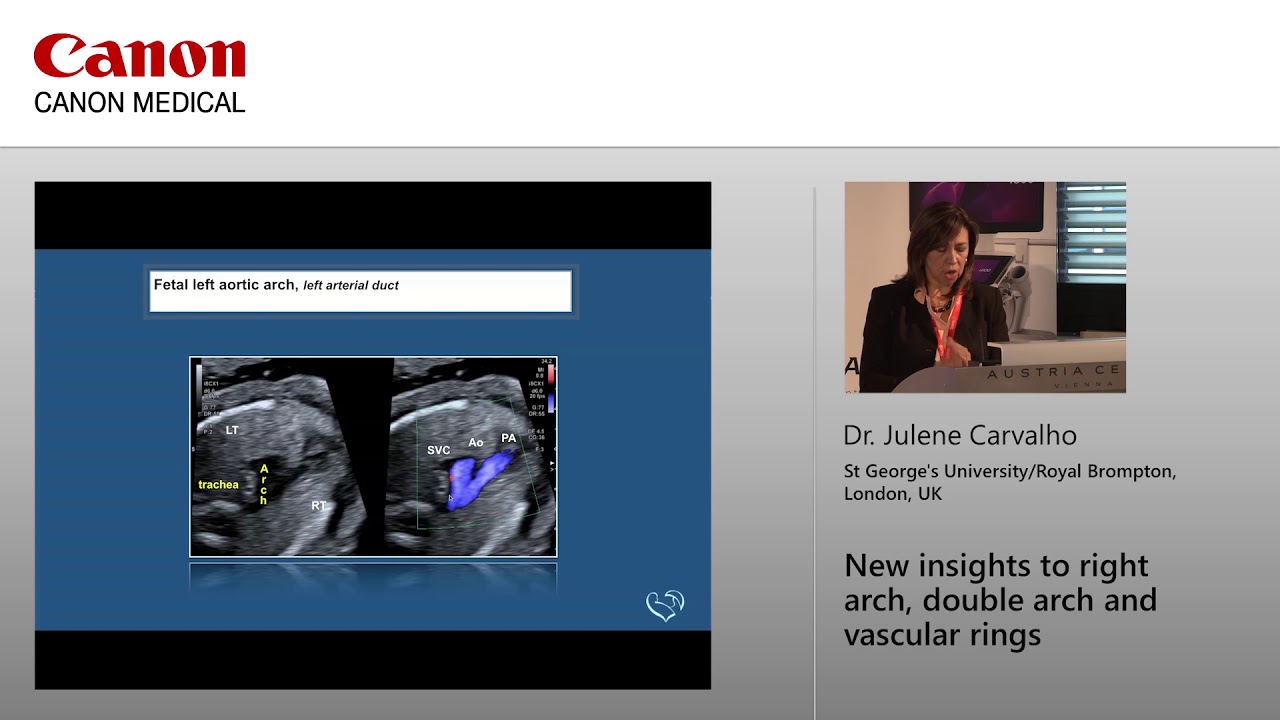 Dr Julene Carvalho - New Insights to Right Arch, Double Arch and Vascular Rings