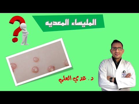 المليساء المعدية داء اللؤلؤ