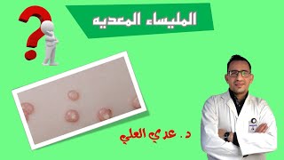 المليساء المعدية ( داء اللؤلؤ )