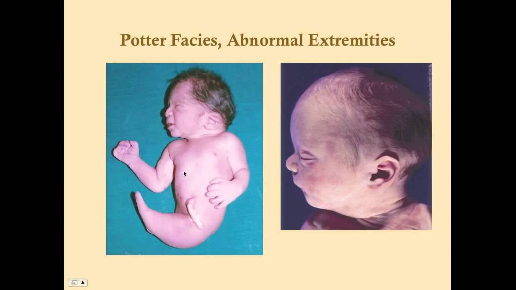 Polycystic Kidney Disease - CRASH! Medical Review Series 