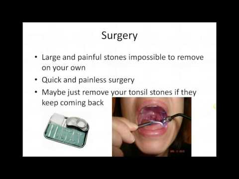 how-to-get-rid-of-tonsil-stones?-natural-tonsil-stones-removal-method