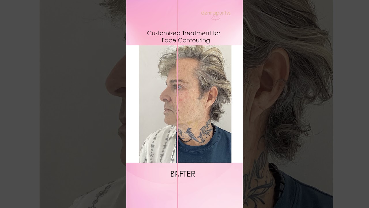 Derma Puritys | Face Shaping & Contouring Before-After